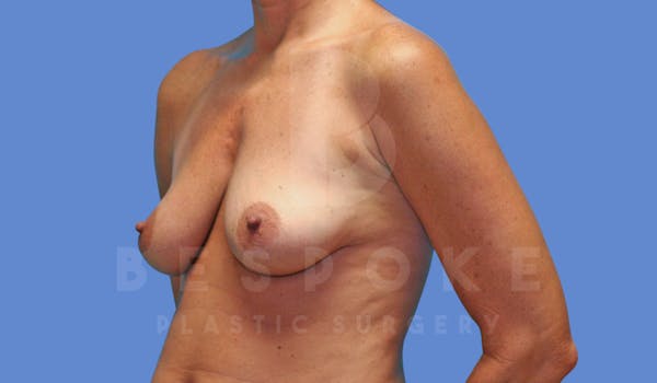 Breast Lift With Implants Before & After Gallery - Patient 144120449 - Image 3