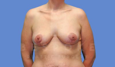 Breast Reduction Before & After Gallery - Patient 144120477 - Image 2
