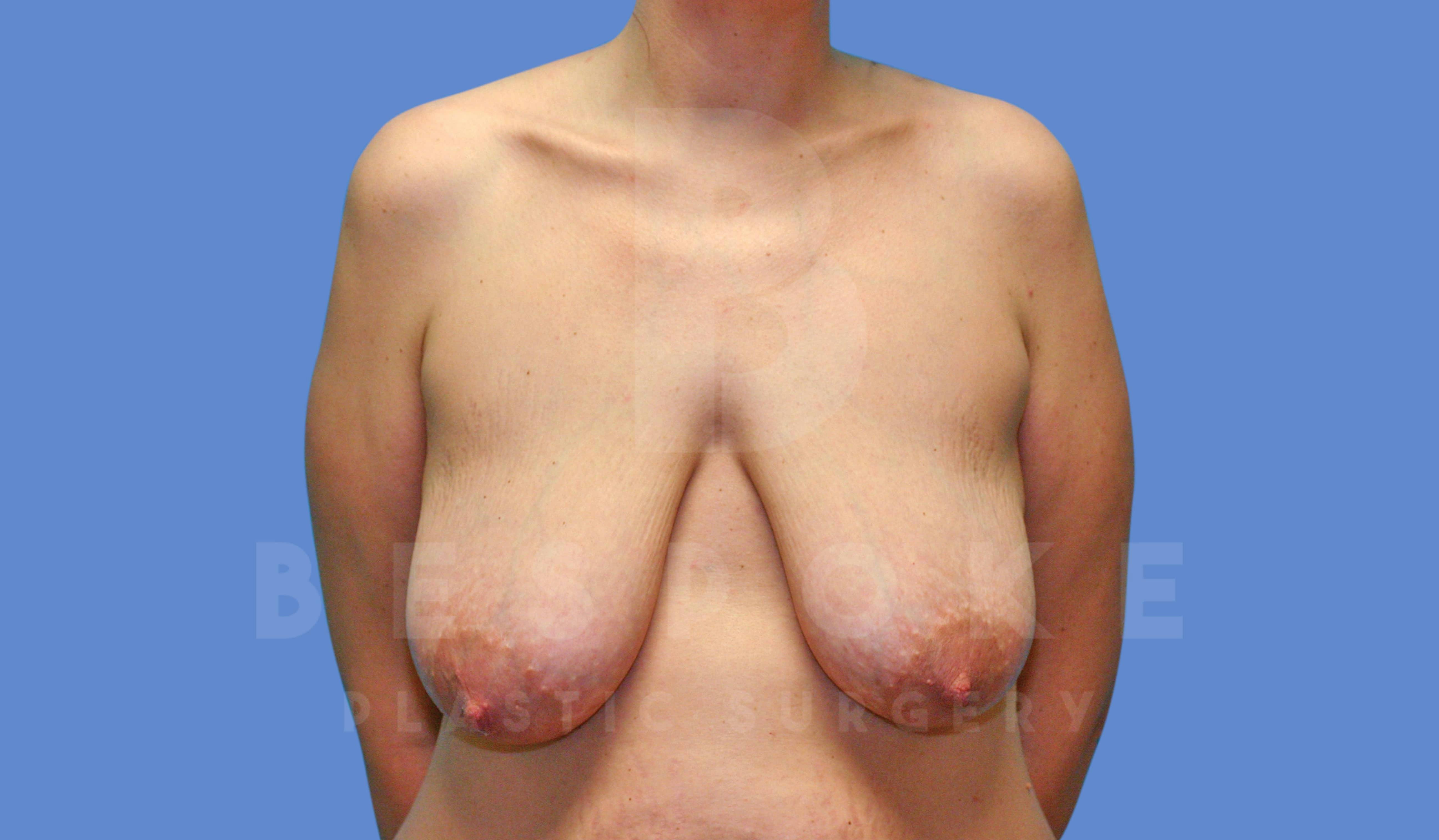 Breast Reduction Before & After Gallery - Patient 144120477 - Image 1