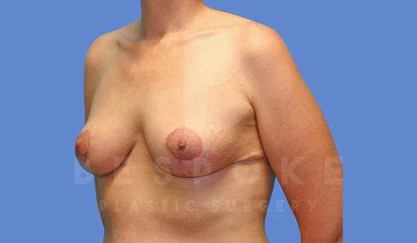 Breast Reduction Before & After Gallery - Patient 144120477 - Image 4