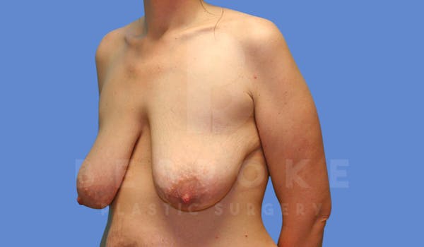 Breast Reduction Before & After Gallery - Patient 144120477 - Image 3