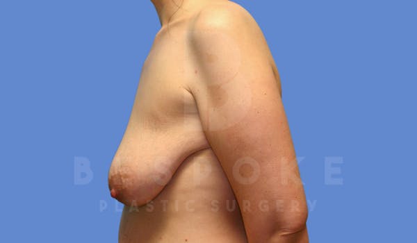 Breast Reduction Before & After Gallery - Patient 144120477 - Image 5