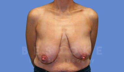 Breast Reduction Before & After Gallery - Patient 144120476 - Image 1