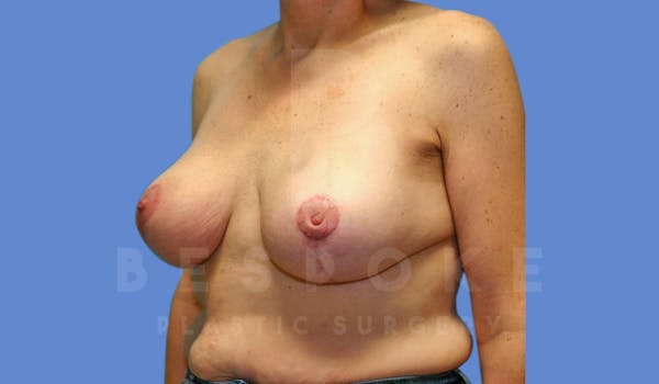 Breast Reduction Before & After Gallery - Patient 144120476 - Image 4