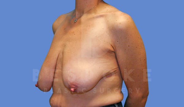 Breast Reduction Before & After Gallery - Patient 144120476 - Image 3