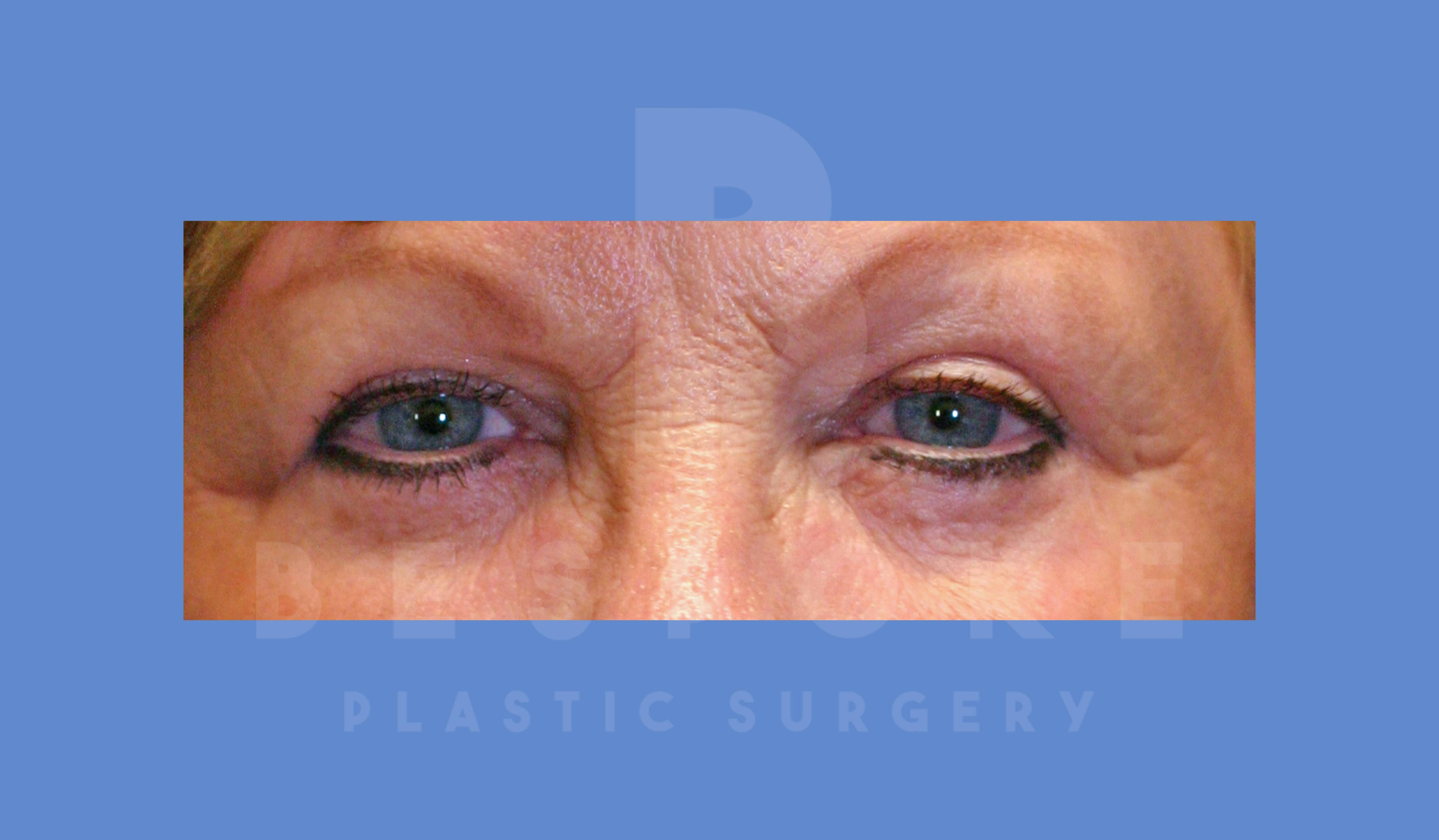 Eyelid Surgery Before & After Gallery - Patient 144120497 - Image 2