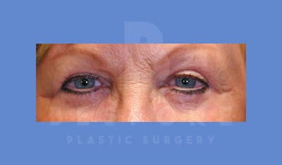 Eyelid Surgery Before & After Gallery - Patient 144120497 - Image 2