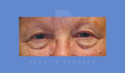 Eyelid Surgery Before & After Gallery - Patient 144120497 - Image 1