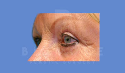 Eyelid Surgery Before & After Gallery - Patient 144120497 - Image 4