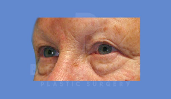 Eyelid Surgery Before & After Gallery - Patient 144120497 - Image 3