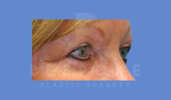 Eyelid Surgery Before & After Gallery - Patient 144120497 - Image 6