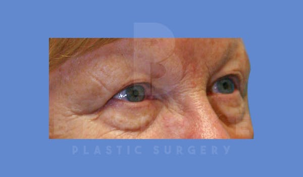 Eyelid Surgery Before & After Gallery - Patient 144120497 - Image 5