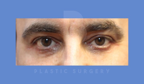 Eyelid Surgery Before & After Gallery - Patient 144120496 - Image 2