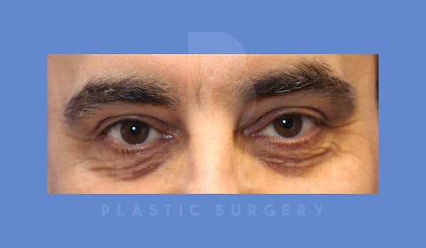 Eyelid Surgery Before & After Gallery - Patient 144120496 - Image 1