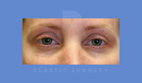 Facial Fat Grafting Before & After Gallery - Patient 144120534 - Image 2