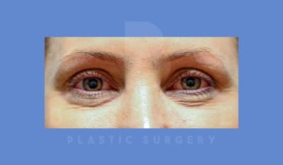 Facial Fat Grafting Before & After Gallery - Patient 144120534 - Image 1