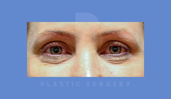 Facial Fat Grafting Before & After Gallery - Patient 144120534 - Image 1