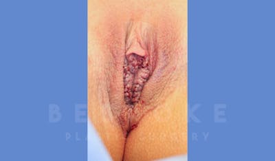 Labiaplasty Before & After Gallery - Patient 144120543 - Image 2