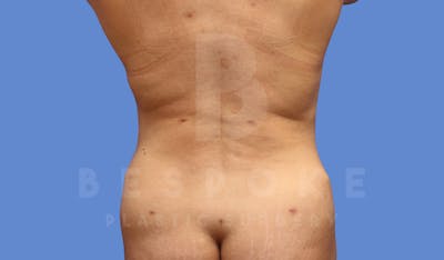 Liposuction Before & After Gallery - Patient 144120557 - Image 2