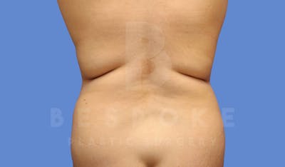 Liposuction Before & After Gallery - Patient 144120557 - Image 1