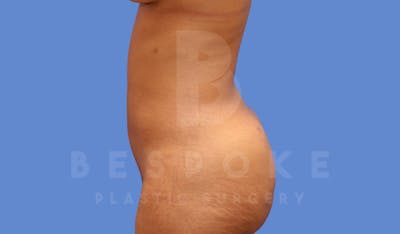 Liposuction Before & After Gallery - Patient 144120556 - Image 6