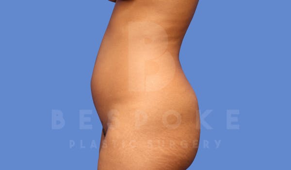 Liposuction Before & After Gallery - Patient 144120556 - Image 5