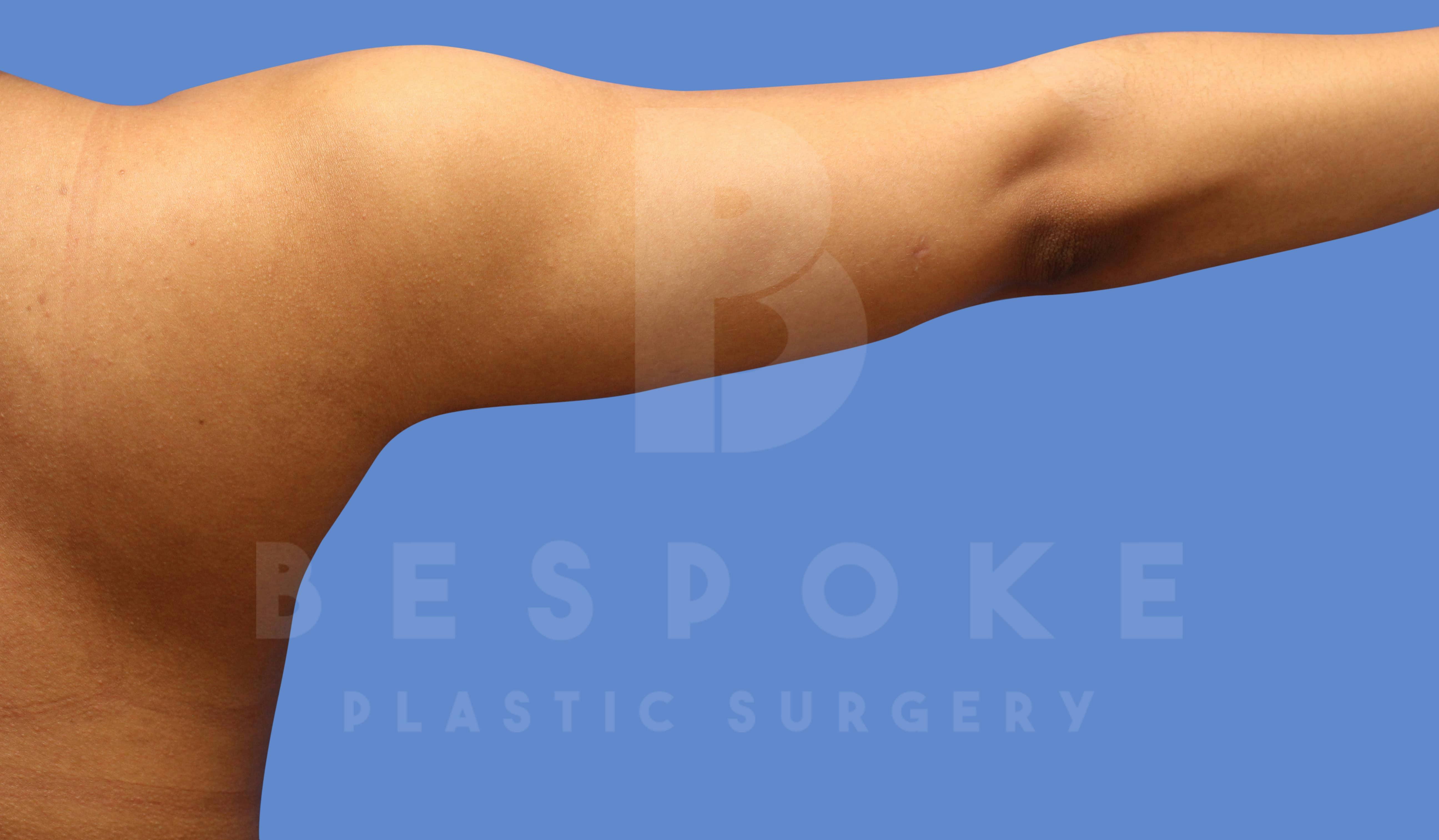 Liposuction Before & After Gallery - Patient 144120555 - Image 2