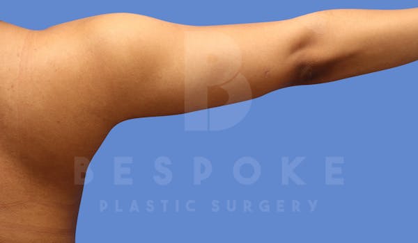 Liposuction Before & After Gallery - Patient 144120555 - Image 2