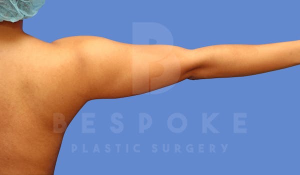 Liposuction Before & After Gallery - Patient 144120555 - Image 1