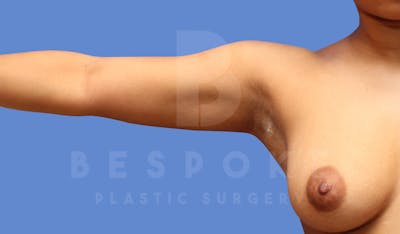 Liposuction Before & After Gallery - Patient 144120555 - Image 4