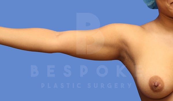 Liposuction Before & After Gallery - Patient 144120555 - Image 3