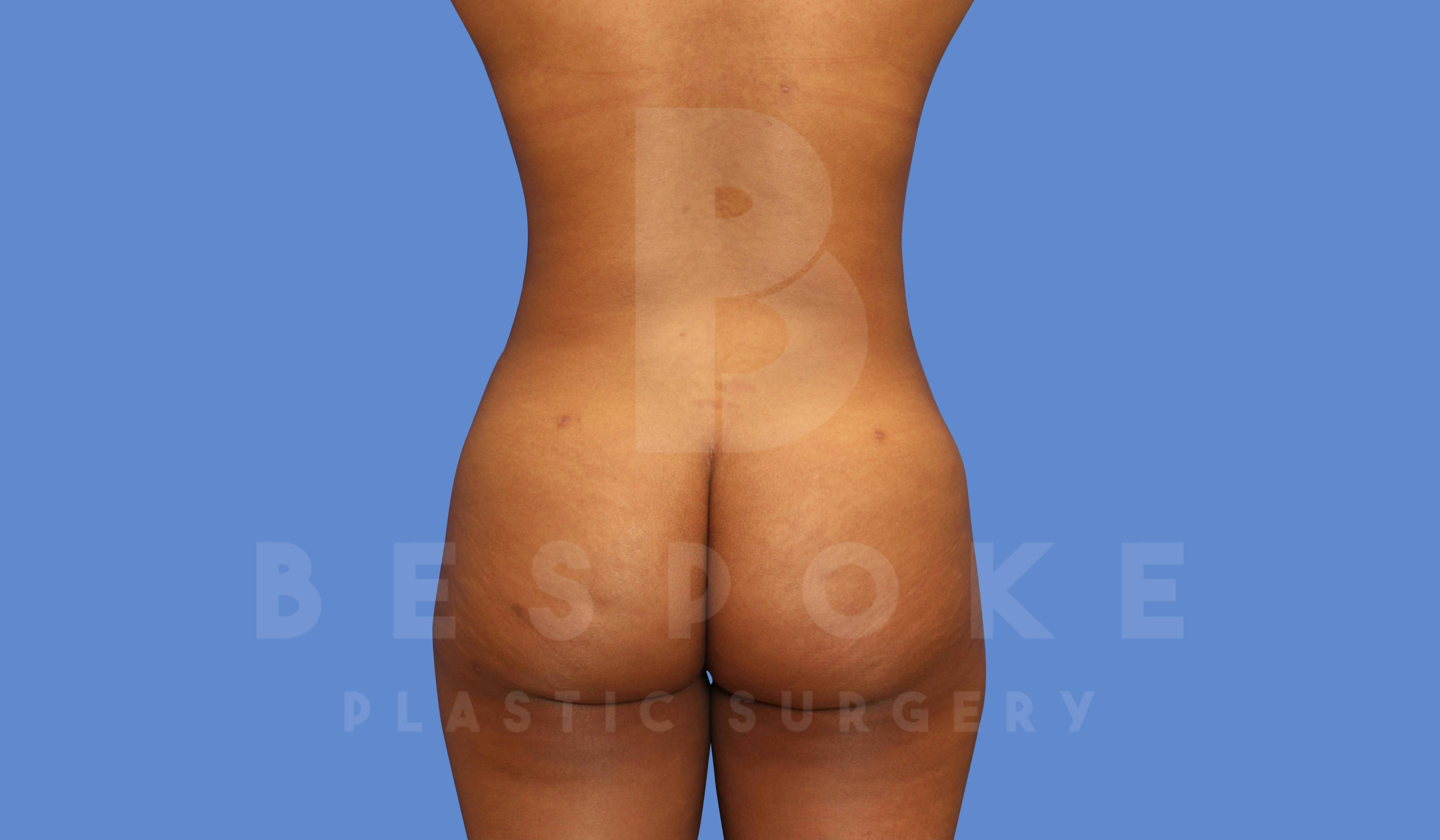 Liposuction Before & After Gallery - Patient 144120554 - Image 2