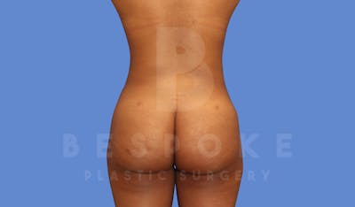 Liposuction Before & After Gallery - Patient 144120554 - Image 2