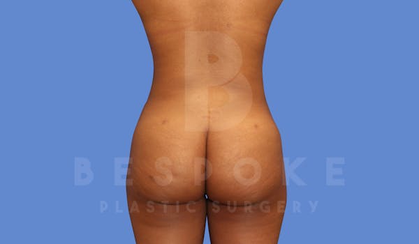Liposuction Before & After Gallery - Patient 144120554 - Image 2