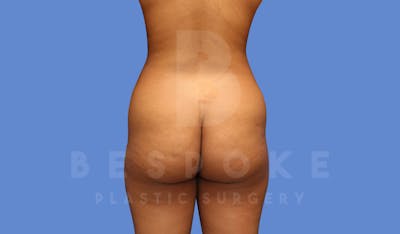 Liposuction Before & After Gallery - Patient 144120554 - Image 1