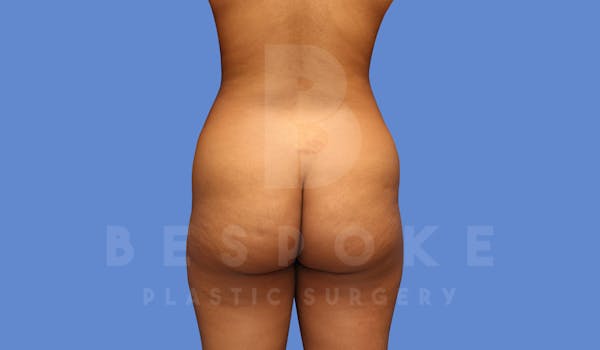 Liposuction Before & After Gallery - Patient 144120554 - Image 1