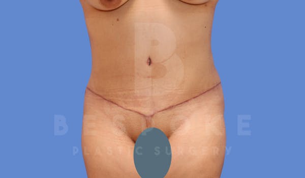 Tummy Tuck Before & After Gallery - Patient 144120579 - Image 2