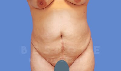 Tummy Tuck Before & After Gallery - Patient 144120579 - Image 1