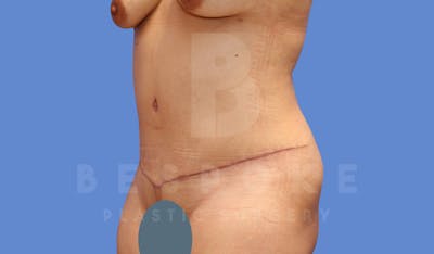 Tummy Tuck Before & After Gallery - Patient 144120579 - Image 4
