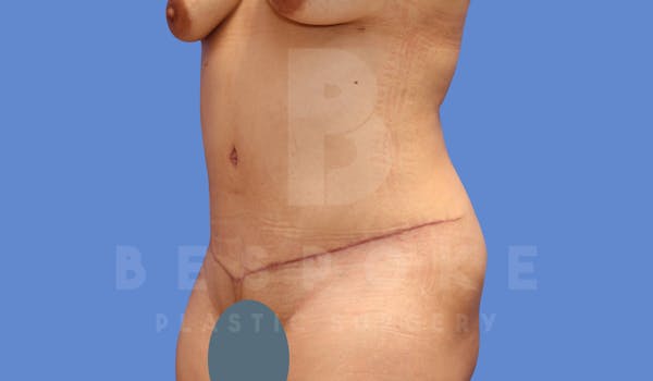 Tummy Tuck Before & After Gallery - Patient 144120579 - Image 4