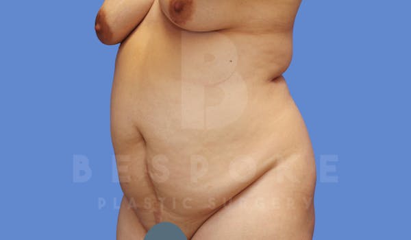 Tummy Tuck Before & After Gallery - Patient 144120579 - Image 3