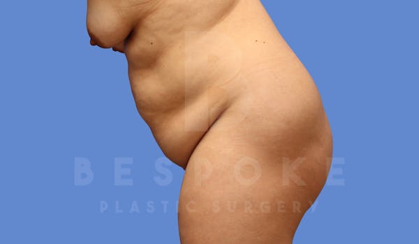 Tummy Tuck Before & After Gallery - Patient 144120579 - Image 5
