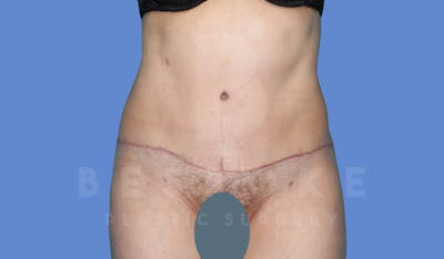 Tummy Tuck Before & After Gallery - Patient 144120578 - Image 2
