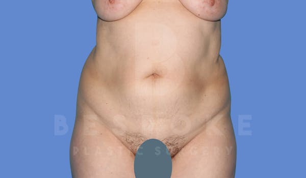 Tummy Tuck Before & After Gallery - Patient 144120578 - Image 1