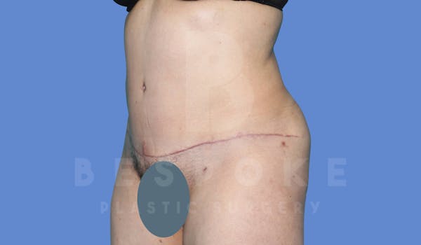 Tummy Tuck Before & After Gallery - Patient 144120578 - Image 4