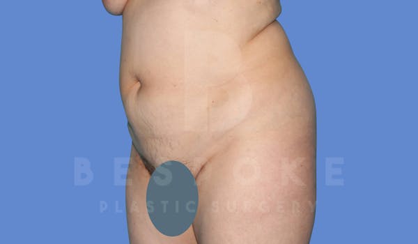 Tummy Tuck Before & After Gallery - Patient 144120578 - Image 3