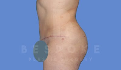 Tummy Tuck Before & After Gallery - Patient 144120578 - Image 6