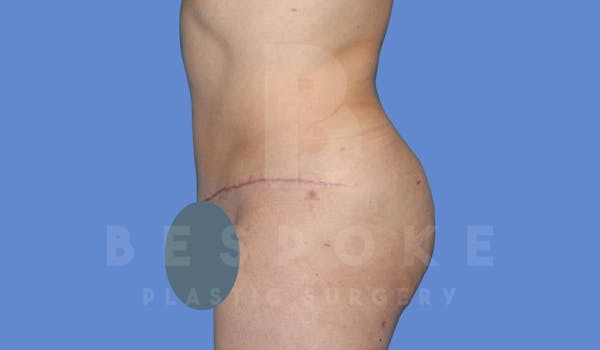 Tummy Tuck Before & After Gallery - Patient 144120578 - Image 6