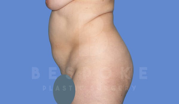 Tummy Tuck Before & After Gallery - Patient 144120578 - Image 5