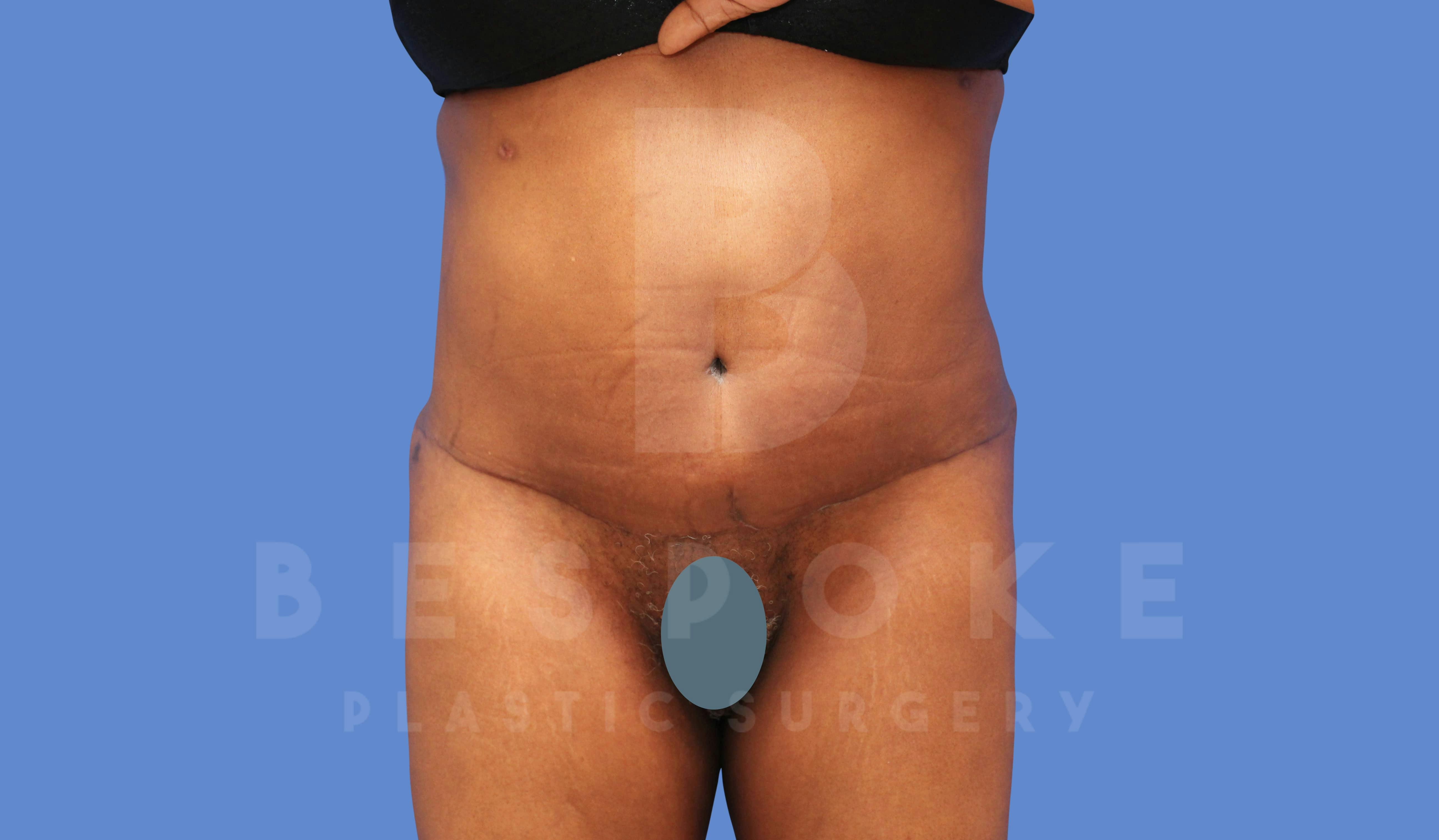 Tummy Tuck Before & After Gallery - Patient 144120577 - Image 2